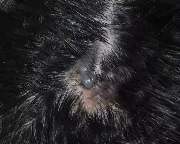 长沙一男子头上的胎记长出会长大的肉痣医生却这样说