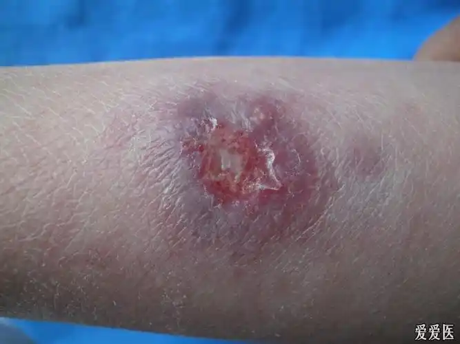 近期十例孢子丝菌病 - 皮肤及性传播疾病讨论版 - 爱爱医医学论坛