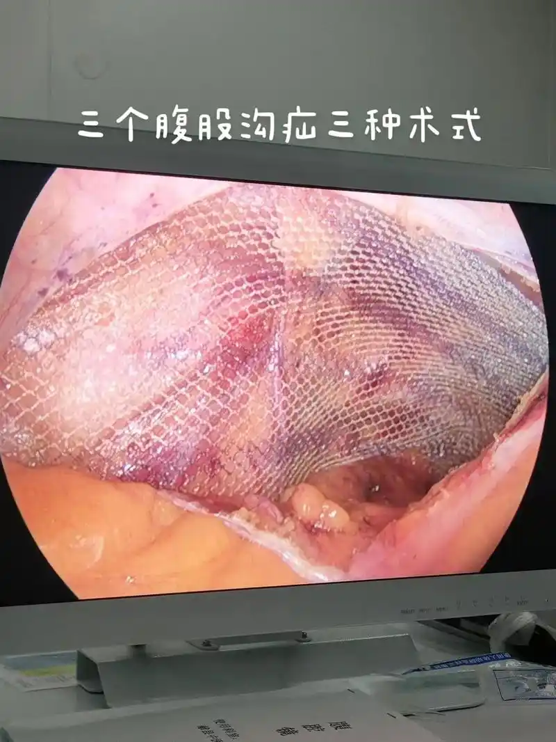 今日手术分享:三个腹股沟疝,三种术式.①老年男性,右侧直疝, - 抖音