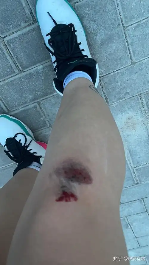 回家自己处理的伤口,拿出纱布准备包扎男朋友说我小题大做,一点皮外伤