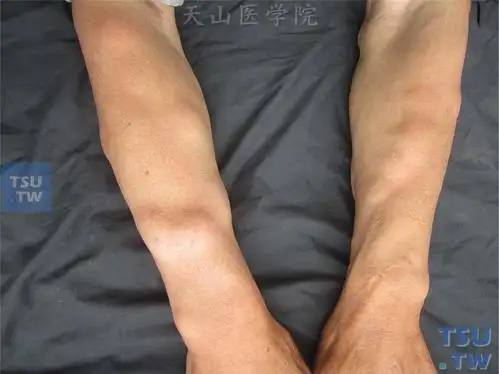 良性肿瘤:脂肪瘤(lipoma)症状表现 - 皮肤病诊断图谱 - 天山医学院