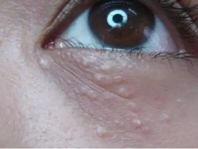 汗管瘤图片眼部图片 (4)