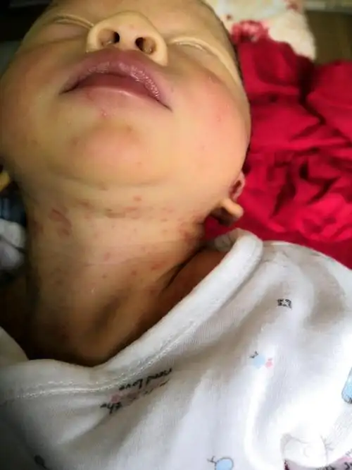 宝宝脖子上都是这个,脸上也有.脖子一大片都是,看着都难受