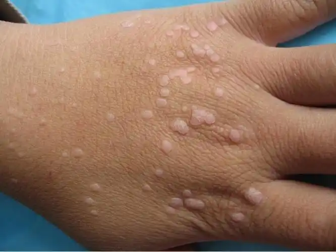 皮肤结核病图片_皮肤结核病症状表现图片大全_有来医生