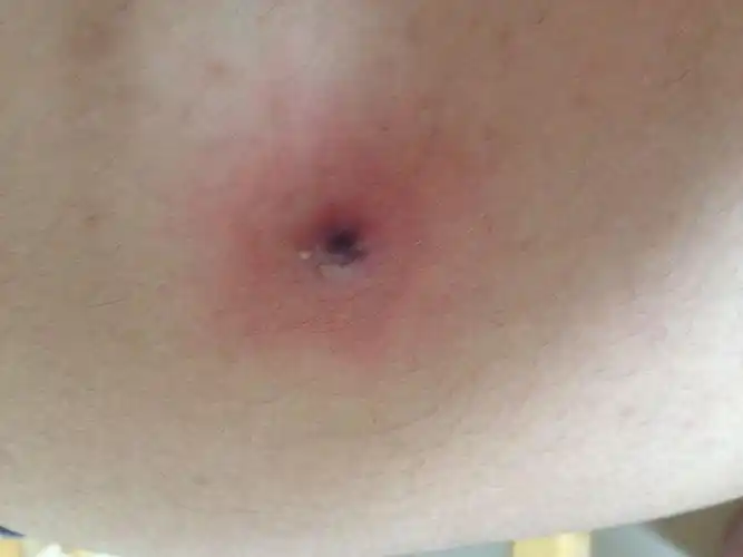 问:右边的大腿右侧肿起来了个直径三厘米的东西…… 挺硬的里面还有脓