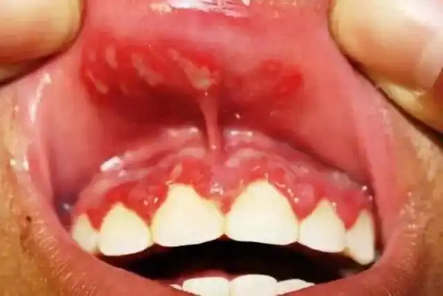 手足口病进入高发期,14 种鉴别诊断,你掌握了吗? - 丁香园