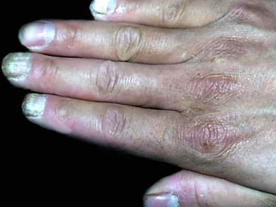 最终累及大部,全部甚至两侧手掌,损害为红斑,水疱,鳞屑和角化增厚,应