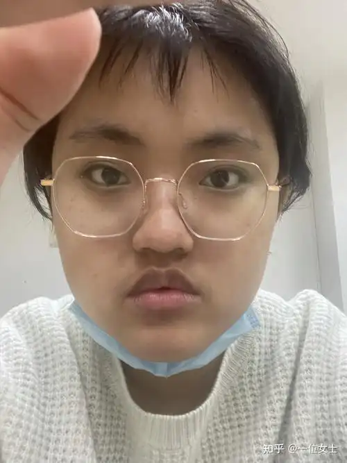 记录吃激素满月脸的恢复状况