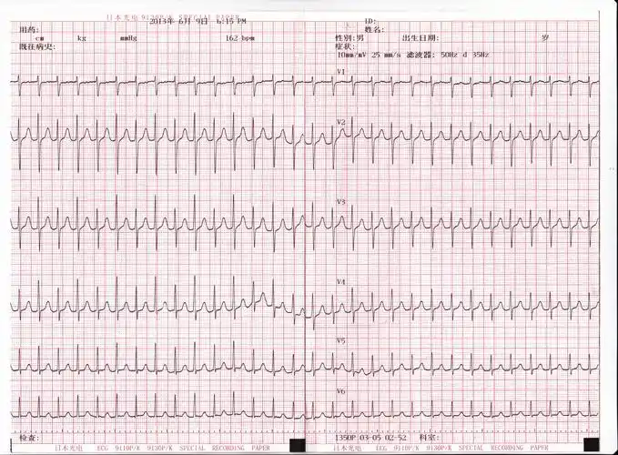请问引起室上性心动过速的原因?需要手术吗?
