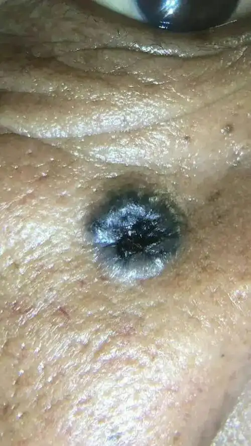 从米粒大小一年长成蚕豆八旬老人老年斑原是基底细胞癌