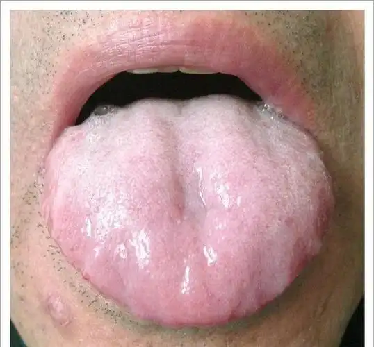 舌质色:淡白,淡紫;形:胖大,齿痕,嫩.舌苔苔质:根偏厚腻,湿滑;苔色:白.