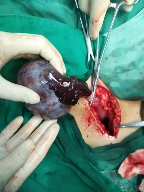 卵巢囊肿蒂扭转两例