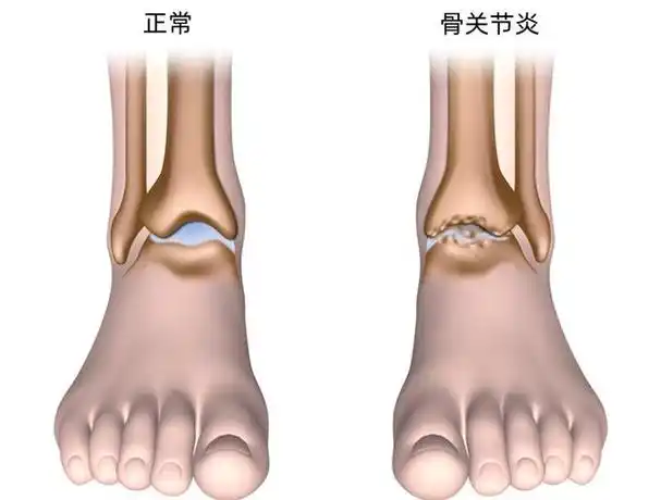走路时,脚踝发出噼啪声,是疾病的信号吗?