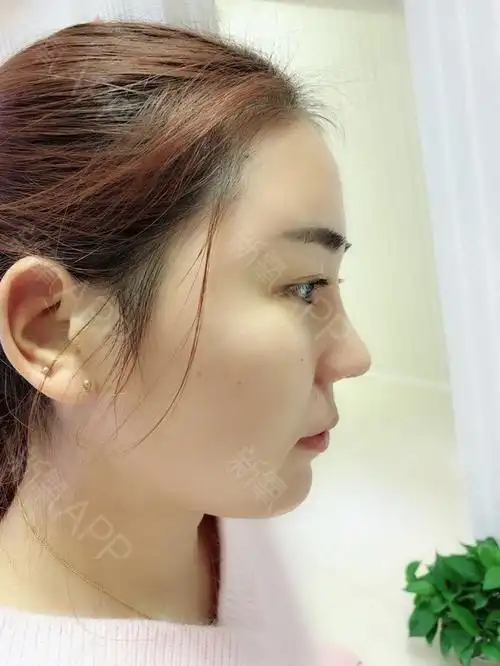 膨体隆鼻好不好_效果图_kawaii仙女膨体隆鼻术后第8天_新氧美容整形