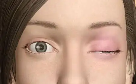 老年人重症肌无力会引发什么疾病?