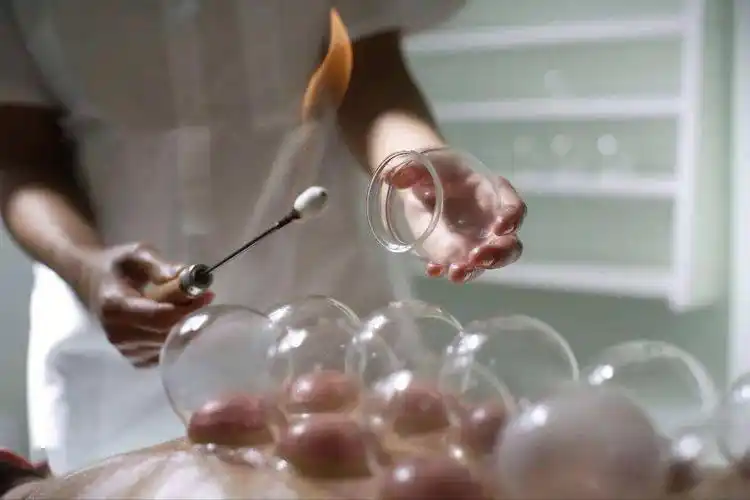 南岸医院中医科哪家好?拔火罐会有啥好处