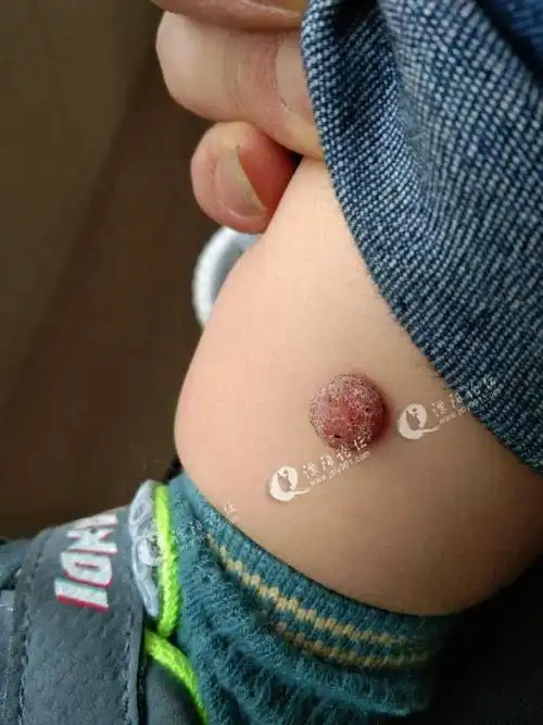 坛友们我14个月大儿子小腿上生了个肉瘊有什么办法吗