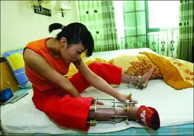 断骨增高术的原理很简单,就是将正常的骨骼弄成骨折,将骨折的骨骼两端