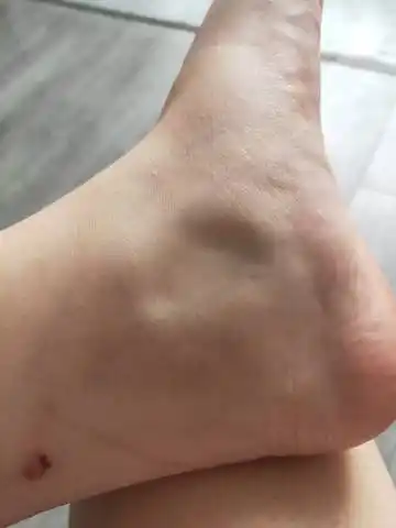 孕四个月,脚踝内侧肿了,这是不是哪里有问题了.