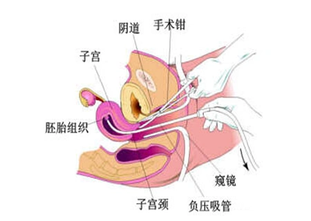 打胎是药流好还是人流好两者区别要明确
