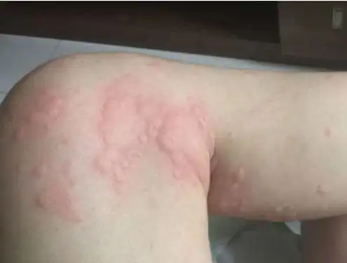 螨虫会引起人体过敏,引发丘疹性荨麻疹,奇痒难忍.