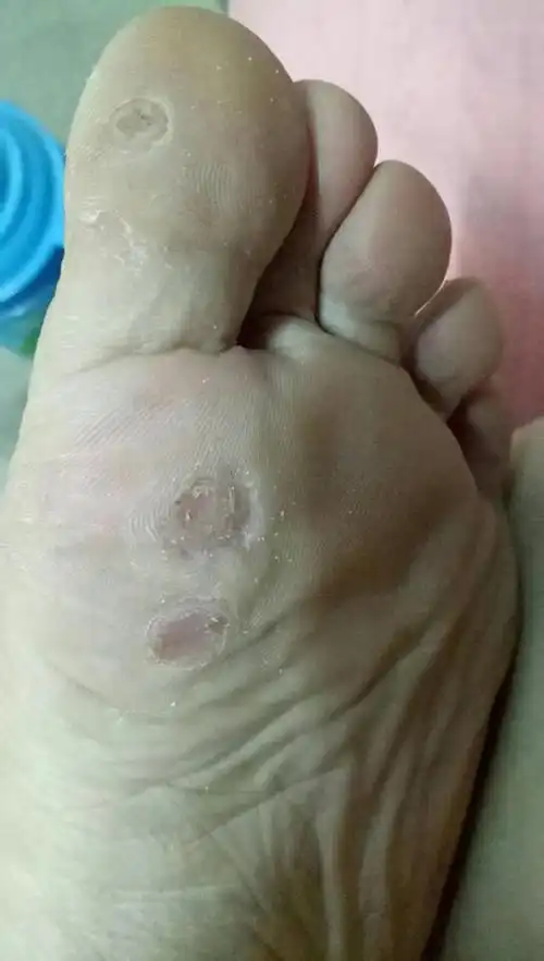 大二学生,发现脚底长了跖疣,从最开始的三个到现在已经有十几颗了,之