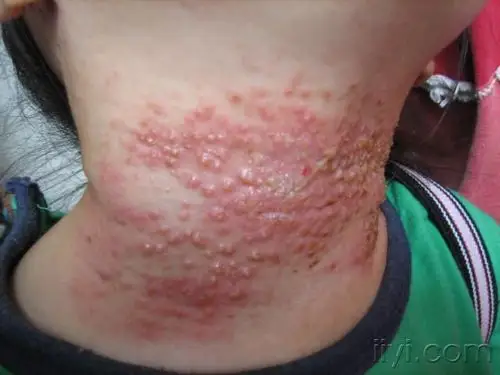 典型的间擦疹1例