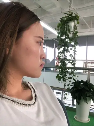 正颌术后70天,她的鼻孔朝天了?