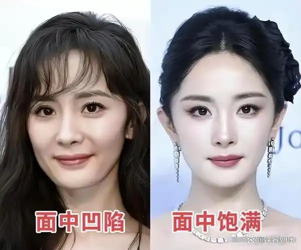 我们的苹果肌下垂,颧骨突出就会变得不可避免,这种状况不仅让我们显得