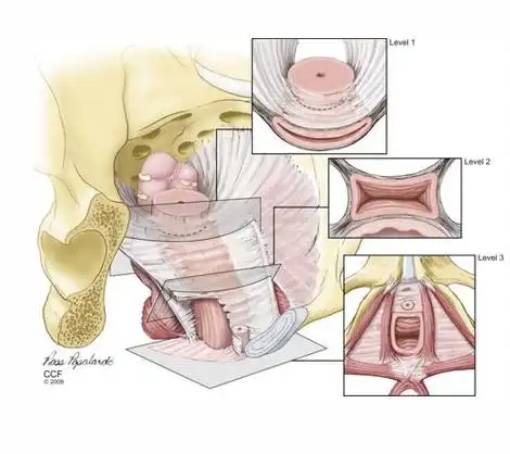 耻骨宫颈筋膜体,阴道筋膜盆底吊床理论盆底肌功能—"性"球海绵体肌