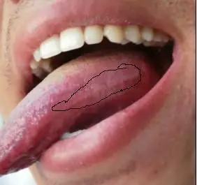 这是口腔毛状白斑吗