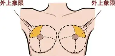 胸大的女人更容易患乳腺癌?