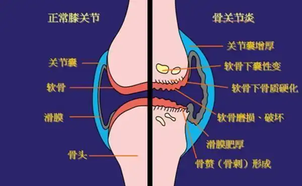 原发性骨关节病的基本病因是,人体成熟后的逐渐老化及退行性变,在骨