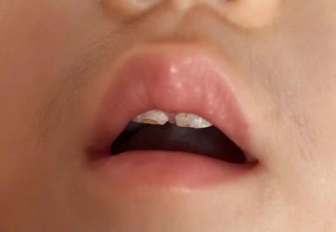 才一岁牙就这样了0901,不知道是钙化还是龋齿了,该怎么办, - 抖音