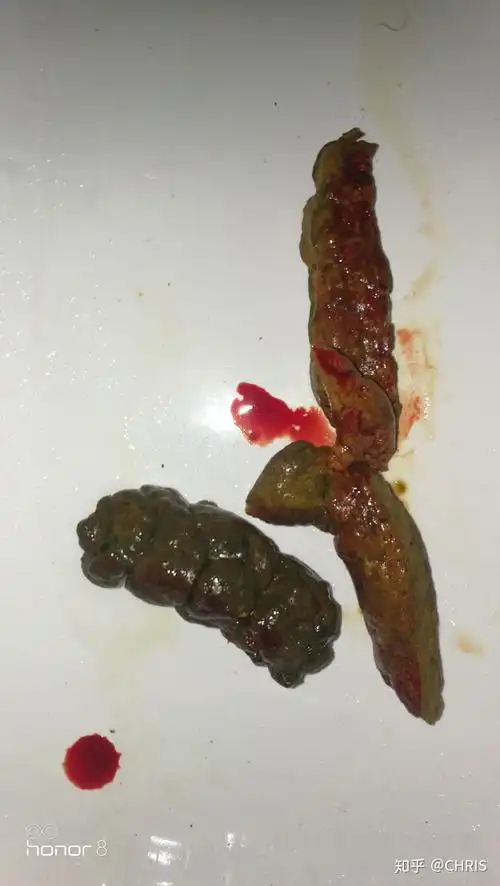 便血一周了,有基础性疾病慢性肠炎和痔疮,很郁闷,疫情期间看病很不