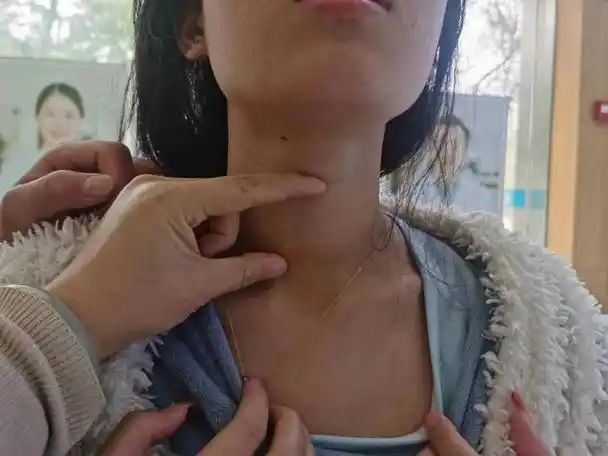 17岁女孩罹患甲亢,2年未治脖子粗大,导致严重自卑心理!