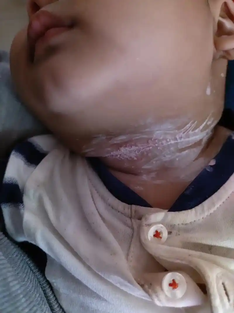 出牙期口水多,宝宝脖子起这种疙瘩,炉甘石涂抹有一段时间不见效 - 抖