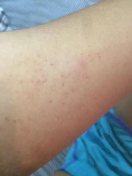 皮肤出现小血点