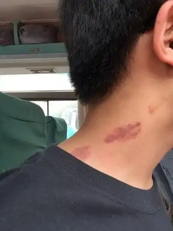 草莓印怎么快速消除掉一小时内,技能|如何彻底祛除吻痕 - 趣测网