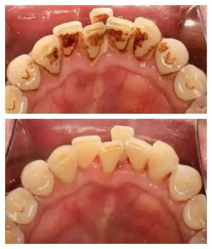 首页 牙周治疗 洗牙   好在牙结石和牙菌斑去除其实也有克星,那就是