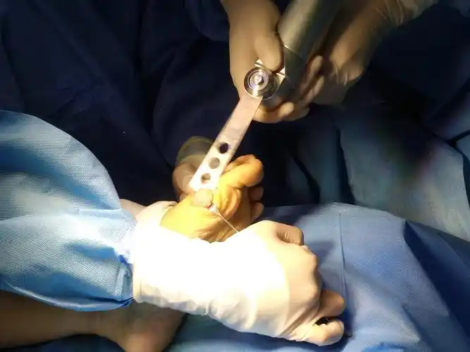 骨一科中年女性患者双足严重踇外翻畸形矫正术手术纪实