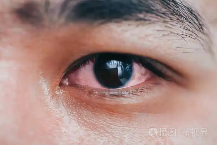 病态红眼