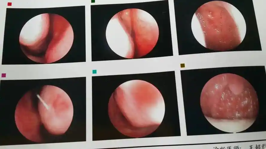 鼻子经常堵,里面有鼻涕但擤不出来,而且鼻子堵的厉害与否常与温度变化