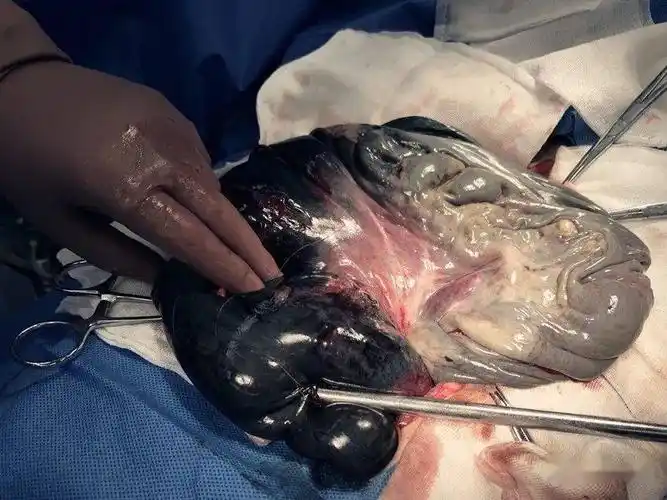 便秘让他被割一米多肠子