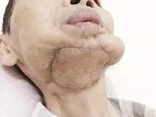 曾经治病救人的名药如今致病害人的毒药槟榔口腔癌