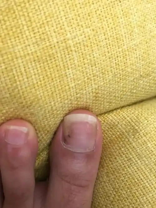 请问这是怎么了 脚趾甲盖上黑点儿什么感觉指甲要掉了