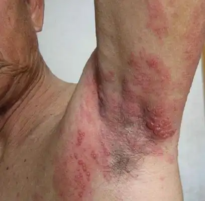 艾滋病的症状 (34)_有来医生