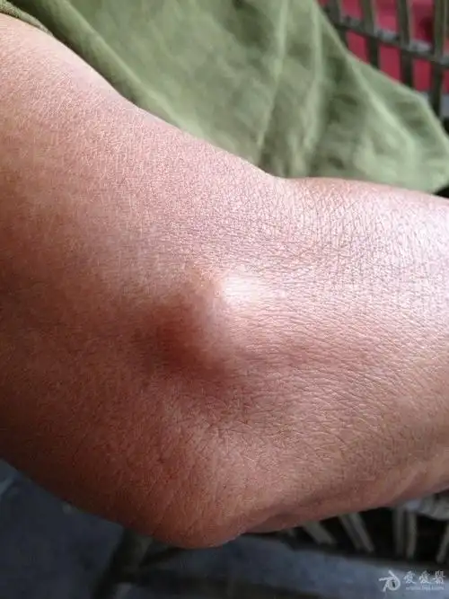 右手肘关节肿物