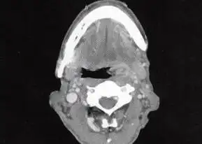 【读片时间】第0623期:扁桃体癌