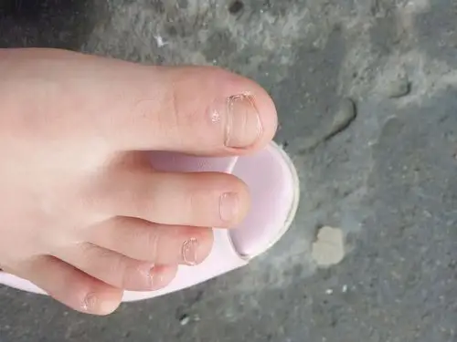 我的两个大脚趾头上面凹凸不平有条横纹下面有时有白白的东西